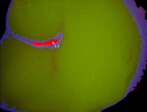 CamX Spectra Caries Detection Aid