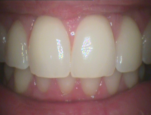 CamX Elara IntraOral Camera